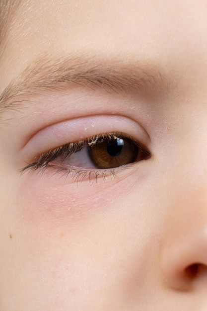 Occhio di un bambino con congiuntivite infiammazione del primo piano della congiuntiva