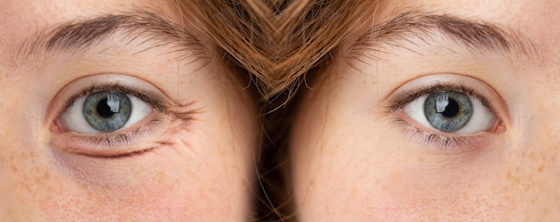 Occhio gonfio di donna prima e dopo il trattamento di rimozione