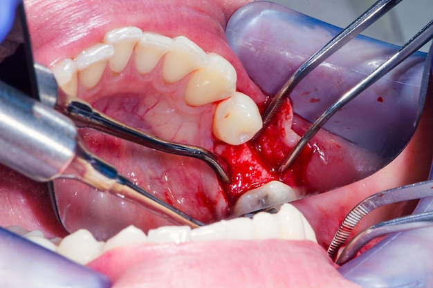 Osso mandibolare aperto dopo l'incisione chirurgica delle gengive con un bisturi prima dell'impianto dentale