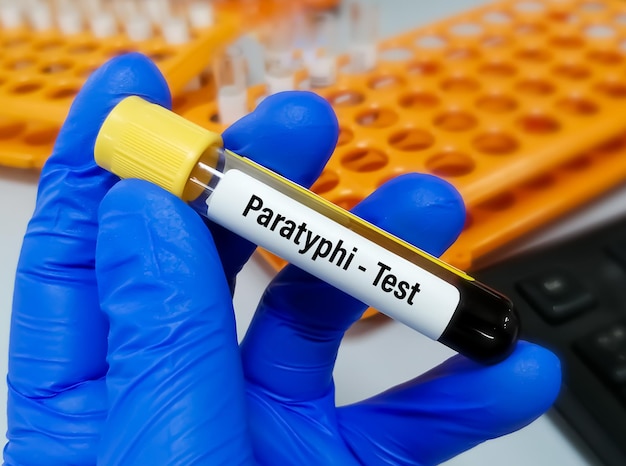 Paratyphi test, per diagnosticare l'infezione da paratifo causata dal batterio Salmonella Paratyphi