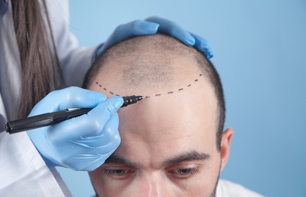 Paziente affetto da perdita di capelli in consultazione con un medico. Medico che utilizza un pennarello per la pelle