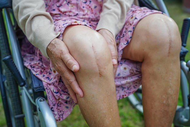 Paziente asiatico anziano con intervento chirurgico di sostituzione del ginocchio cicatriziale in ospedale