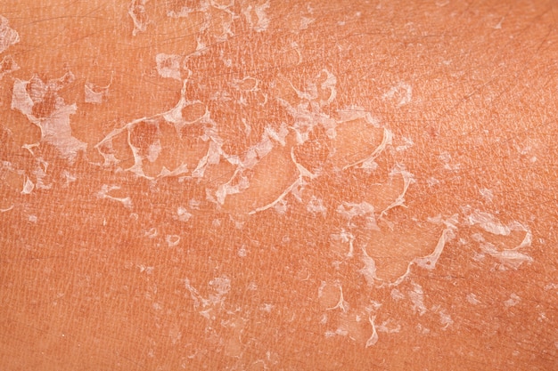 peeling della pelle dopo bruciato dalla luce del sole