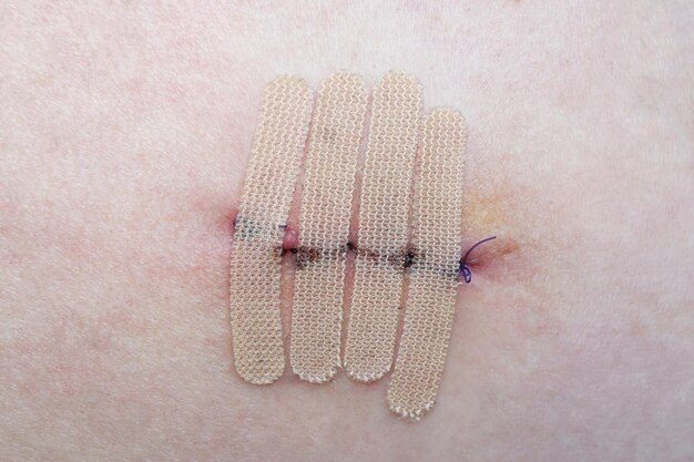 Pelle con strisce di sutura e chiusura della ferita o cerotto chirurgico