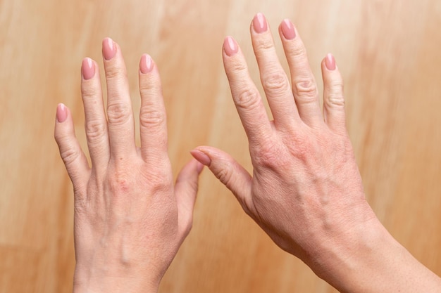 Pelle estremamente secca, disidratata e screpolata della mano di una donna Processo infiammatorio allergico