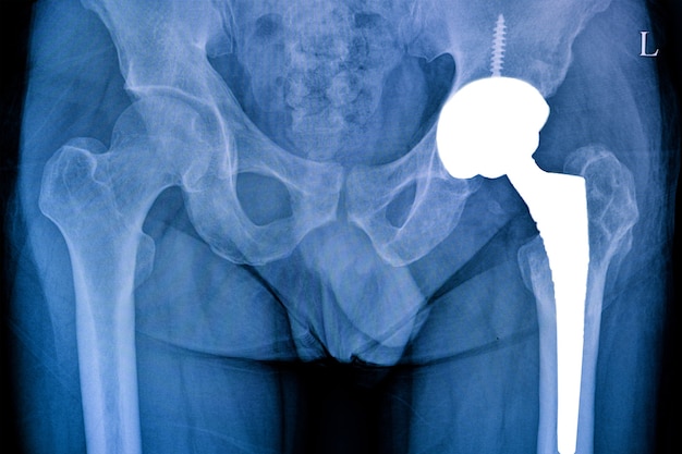 Pellicola radiografica di un paziente con operazione totale dell'anca sinistra con un'articolazione dell'anca protesica