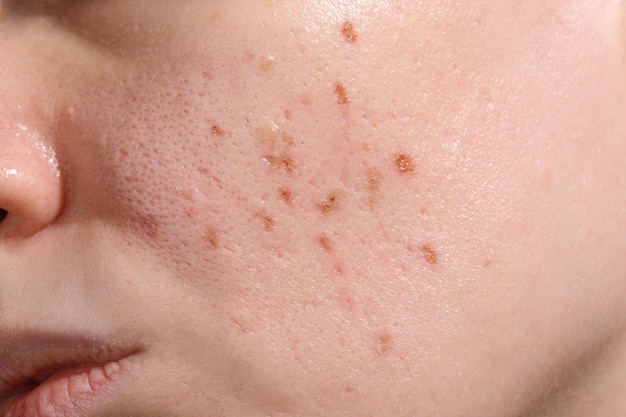 Periodo di guarigione della pelle dopo il resurfacing facciale con laser erbio Trattamento delle cicatrici del picco di ghiaccio Giorno 3