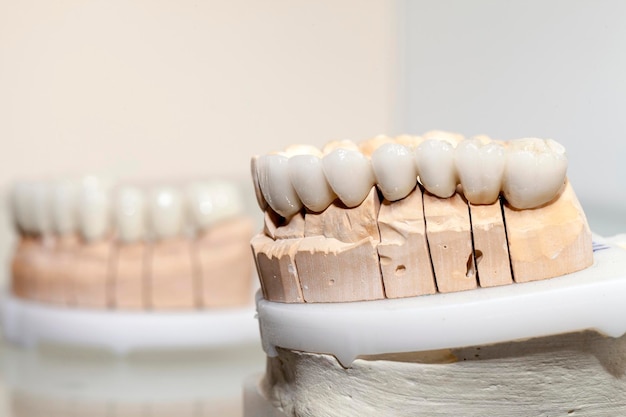 Piastra dentale in porcellana di zirconio nel negozio di dentisti Foto