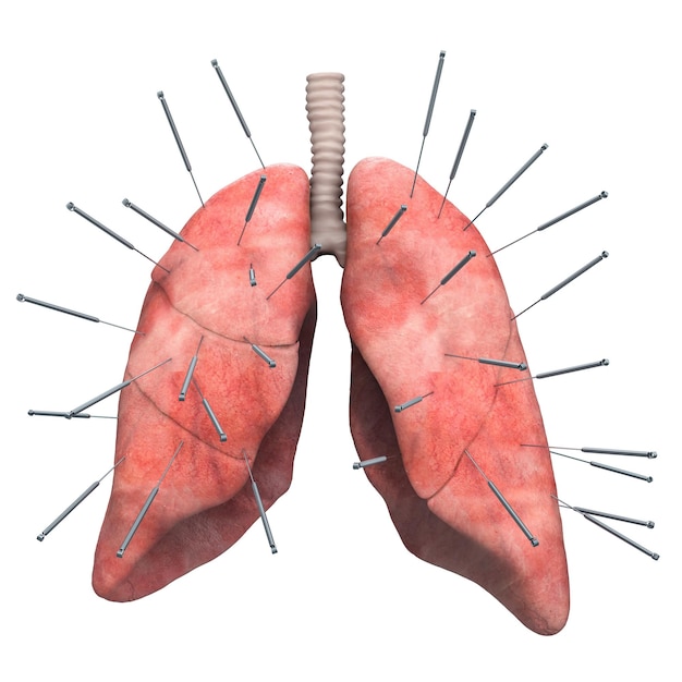 Polmoni umani con aghi di agopuntura Trattamento di agopuntura del concetto di rendering 3D dei polmoni