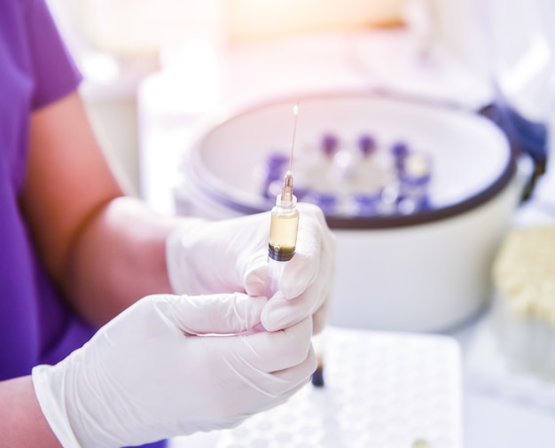 Preparazione del plasma ricco di piastrine. Siringa con plasma nelle mani