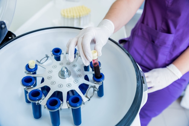 Preparazione del plasma ricco di piastrine. Tubo con sangue nelle mani