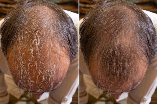 Prima e dopo il trattamento della calvizie Dettagli dei capelli di un uomo