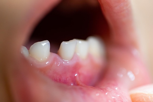 Primo piano dei denti da latte anteriori traballanti del bambino