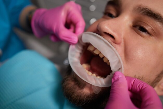 Primo piano dei denti dell'uomo con divaricatore per bocca Paziente dal dentista Malattia dei denti Grave perdita di denti cariati da marciume Prima dei trattamenti