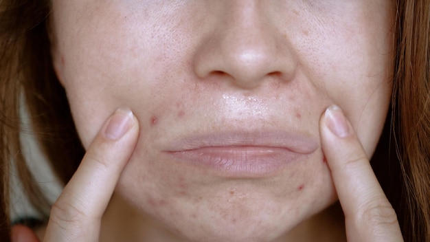 Primo piano dei problemi della pelle pelle malsana con acne e brufoli Demodex poroso e rosacea eruzioni cutanee rosse Il concetto di cura per la pelle problematica Allergia e arrossamento