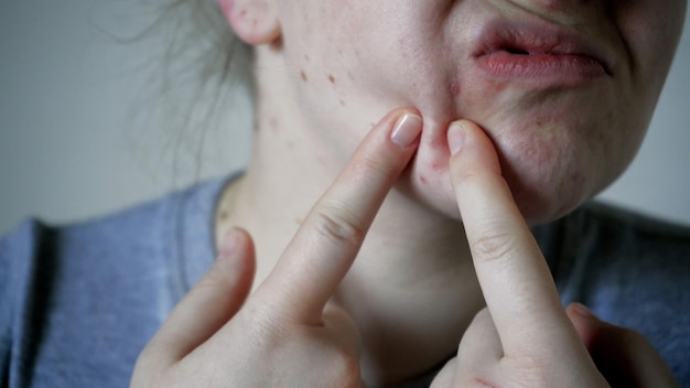 Primo piano dei problemi della pelle pelle malsana con acne e brufoli Demodex poroso e rosacea eruzioni cutanee rosse Il concetto di cura per la pelle problematica Allergia e arrossamento