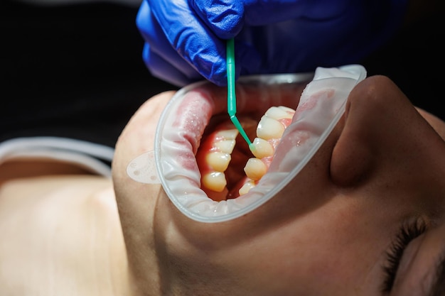 Primo piano del controllo dentale dei denti nello studio dentistico Il dentista esamina i denti dei pazienti con strumenti dentali Messa a fuoco selettiva di odontoiatria