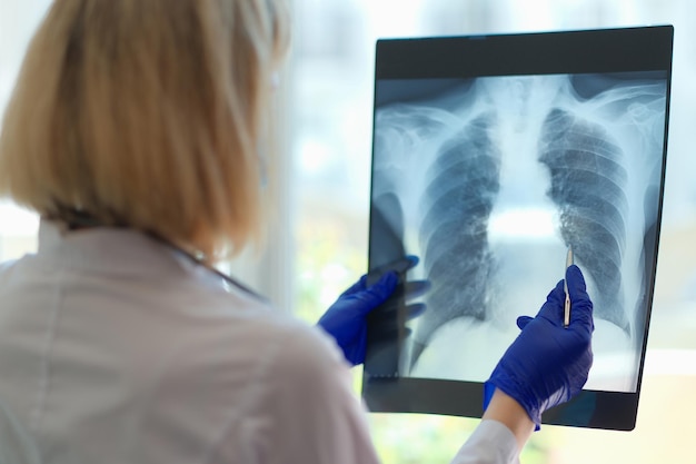 Primo piano del medico che indica l'area danneggiata sul radiologo o sul pneumologo a raggi x del polmone