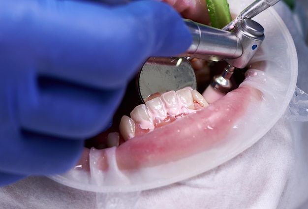 Primo piano del parodontologo che utilizza la lucidatrice dentale e la pulizia dello specchio dei denti del paziente con il divaricatore della guancia nella lucidatura della bocca nella clinica odontoiatrica Concetto di igiene dentale professionale