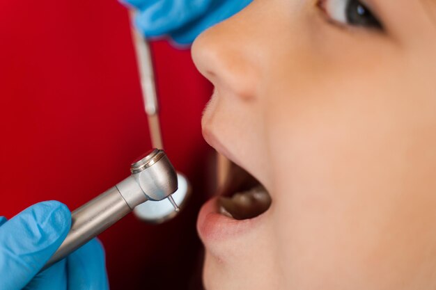 Primo piano del trapano dentale Dentista bambino che perfora i denti della ragazza del bambino nella clinica di odontoiatria Trattamento dei denti Otturazione dentale per il paziente bambino