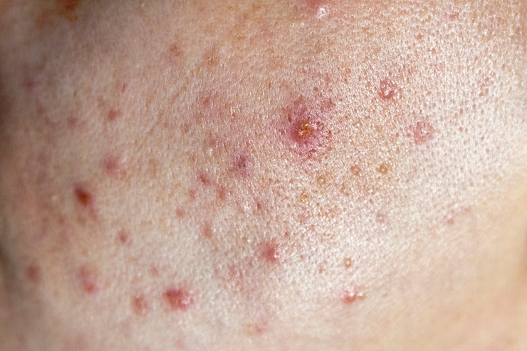 Primo piano del viso di donna con brutta pelle e acne rossa.