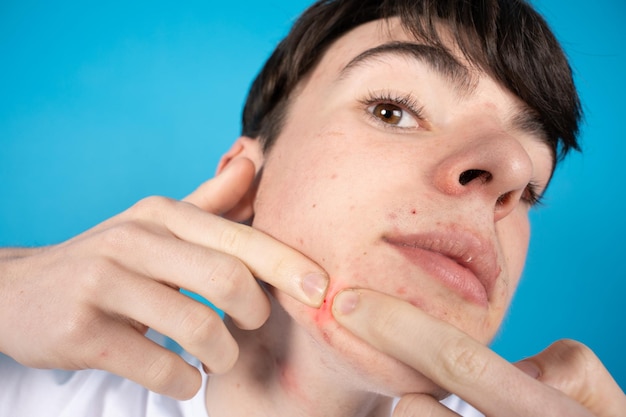 Primo piano dell'adolescente che esplode un brufolo Dermatologia e problemi di acne nel concetto di adolescenza