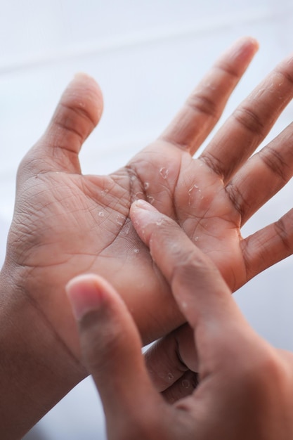 Primo piano della pelle secca e screpolata della mano di un uomo