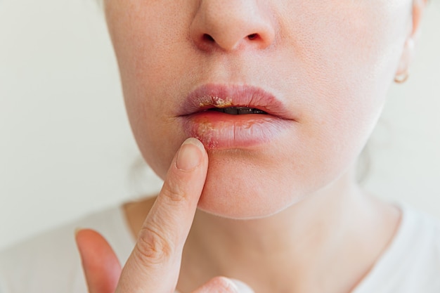 Primo piano delle labbra della ragazza affette da herpes Trattamento dell'infezione da herpes e virus