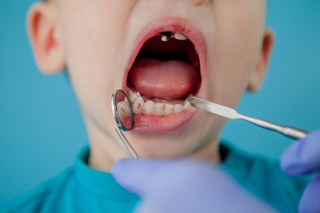 Primo piano delle mani del dentista con assistente in guanti blu stanno trattando i denti a un bambino, il viso del paziente è chiuso