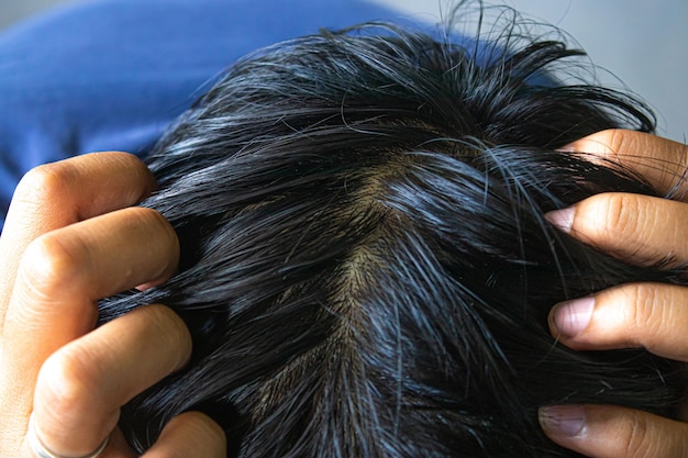 Primo piano di capelli spessi sul cuoio capelluto della testa di un uomo