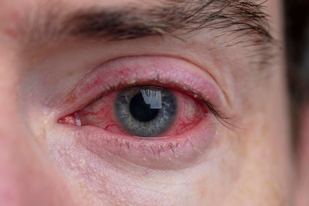 Primo piano di una grave condizione di congiuntivite con blefarite oculare iniettata di sangue