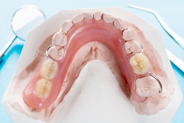 Primo piano, protesi parziale amovibile artificiale o protesi provvisoria parziale su fondo blu.