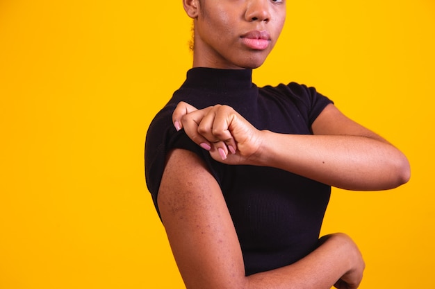 Primo piano sul braccio della donna afro con allergia.