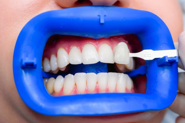 Procedura per confrontare le sfumature di colore dei denti con i test dopo lo sbiancamento