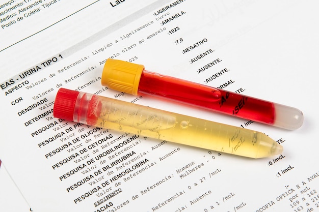 Provetta con analisi delle urine su un foglio con i risultati del test