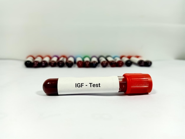Provetta con campione di sangue per il test del fattore di crescita insulino-simile IGF1 o del test della somatomedina C