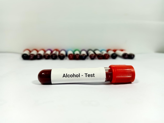 Provetta con campione di sangue per il test dell'alcol Un concetto di test medico sullo sfondo del laboratorio