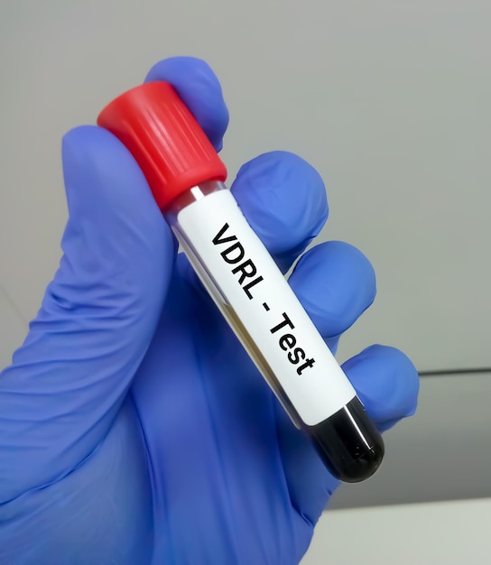 Provetta per campioni di sangue per test di laboratorio di ricerca sulle malattie veneree o VDRL