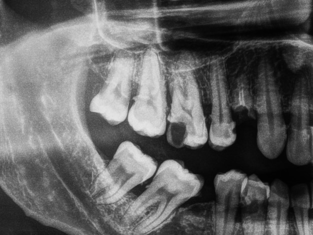 Radiografia dei denti umani in bianco e nero