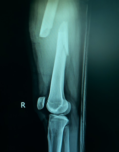 Radiografia del film della frattura della coscia destra.