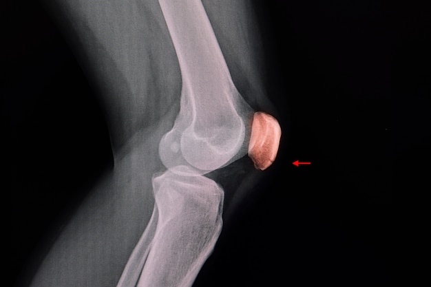 Radiografia del ginocchio di un paziente che mostra una linea sottile nella parte inferiore della rotula