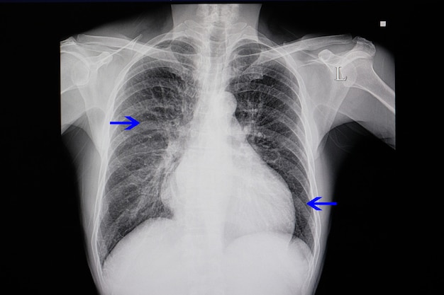 Radiografia del torace di un paziente con insufficienza cardiaca