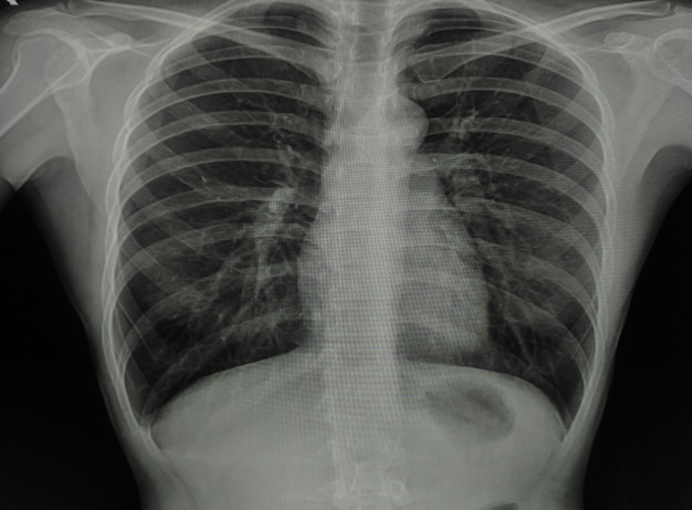 Radiografia del torace normale