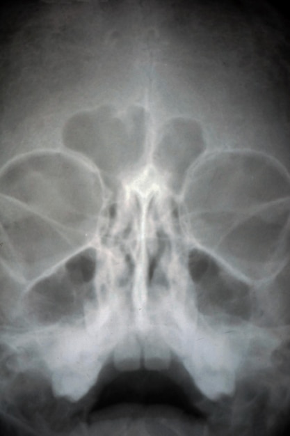 Raggi X di una parte di un primo piano del cranio umano