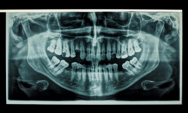 Raggi x panoramici delle ossa dei denti umani