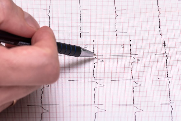 Rapporto grafico ECG su carta, elettrocardiogramma su modulo cartaceo come sfondo