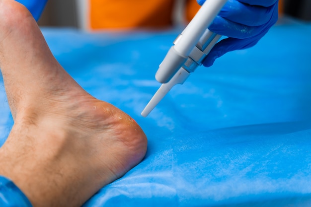 Rimozione laser delle verruche sul piede. Chirurgia dermatologica medica in clinica.