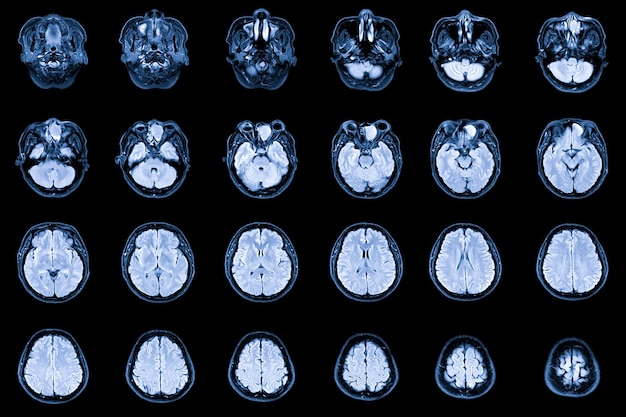 Risonanza magnetica cerebrale e orbitale che mostra l'occupazione dell'etmoide anteriore sinistro e dei seni frontali sinistri