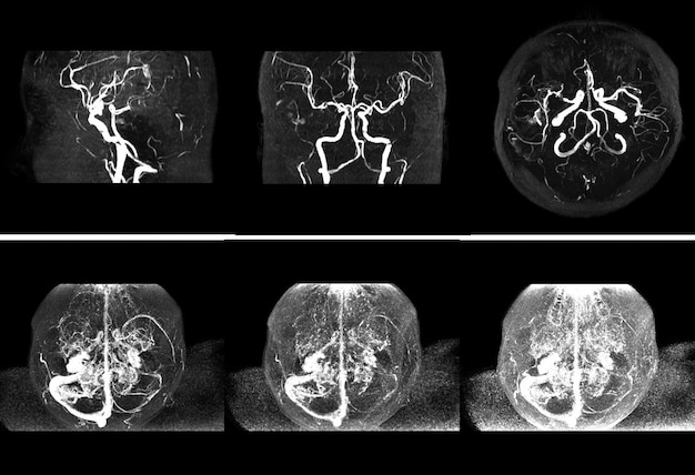 Risonanza magnetica dei vasi sanguigni nel cervello e malattia cerebrovascolare o ictus emorragico.