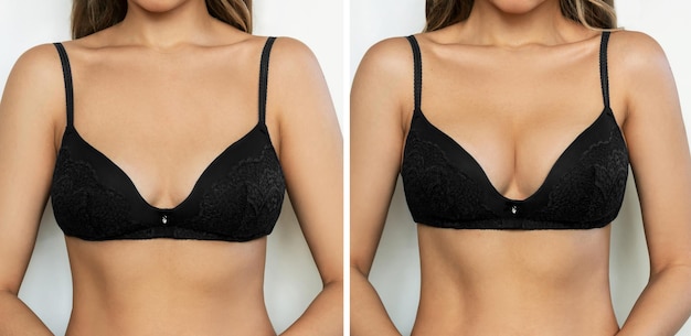 Ritagliata di giovane donna abbronzata in reggiseno prima e dopo l'aumento del seno con protesi al silicone